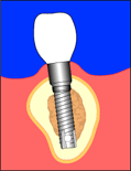 ملف كامل عن طب الاسنان بالصور Implant9