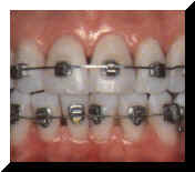 ملف كامل عن طب الاسنان بالصور Brackets