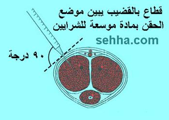 اقوى علاج بالاعشاب للضعف الجنسى وسرعه القذف للرجال فقط EED2