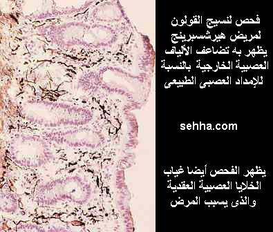 الأمراض الوراثية Genetic Disorders Hirschsprung4