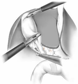 ثورة المناظير تشخيص وعلاج Endoscopy L-Cholysist3