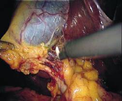 ثورة المناظير تشخيص وعلاج Endoscopy L-Cholysist8