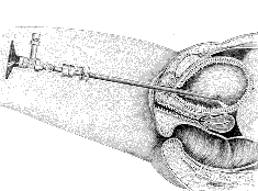 ثورة المناظير تشخيص وعلاج Endoscopy Flex_cystosc_2