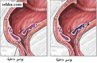 ثورة المناظير تشخيص وعلاج Endoscopy Internalpiles