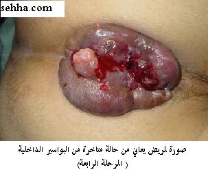 ثورة المناظير تشخيص وعلاج Endoscopy Lastedegree