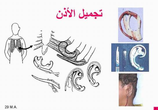 جراحة تجميل الأذن بالصور Otoplasty7