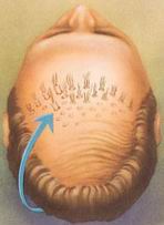 زراعة الشعر Hairtransp0