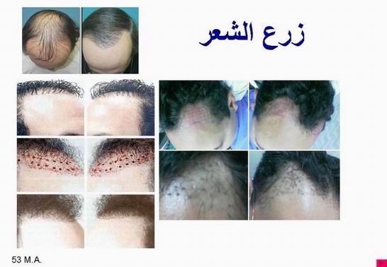 جراحات التجميل والإصلاح Plastic surgeries Hairtransp12