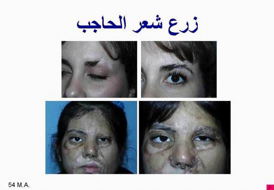 جراحات التجميل والإصلاح Plastic surgeries Hairtransp13