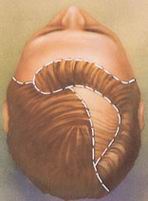 زراعة الشعر Hairtransp2