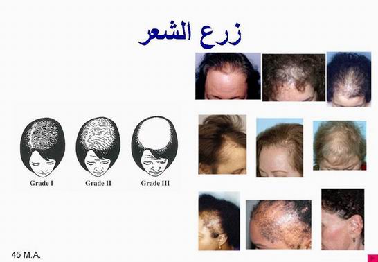 مــلف شامل عن العمليات التجميليه بالصور Hairtransp6