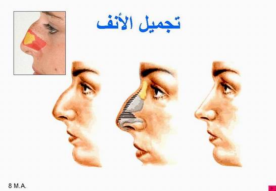 جراحات التجميل والإصلاح Plastic surgeries Rhinoplasty13