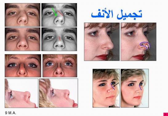 عملية تجميل الانف بالصور Rhinoplasty8