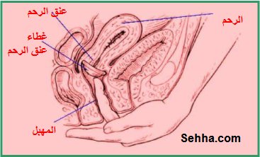 استخدام أقراص منع الحمل The use of oral contraceptives  CervicalCap3