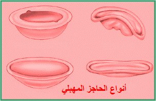 استخدام أقراص منع الحمل The use of oral contraceptives  Diaphragm1