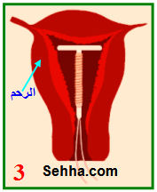 استخدام أقراص منع الحمل The use of oral contraceptives  IUD11