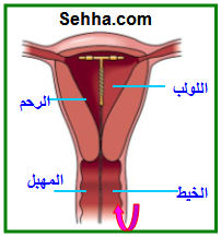 استخدام أقراص منع الحمل The use of oral contraceptives  IUD12