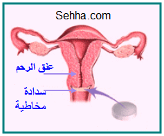 استخدام أقراص منع الحمل The use of oral contraceptives  POC1