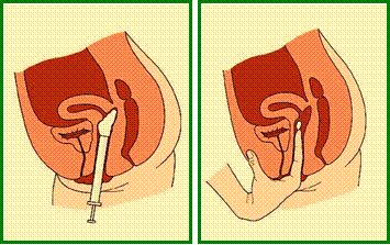 ملف كامل شامل عن وسائل منع الحمل Spermicides5