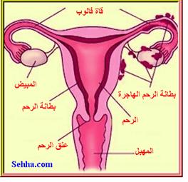 داء بطانة الرحم الهاجرة Endometriosis Endometriosis