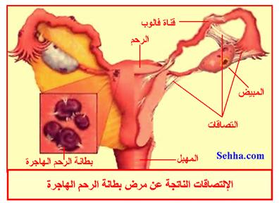 داء بطانة الرحم الهاجرة Endometriosis Endometriosis10