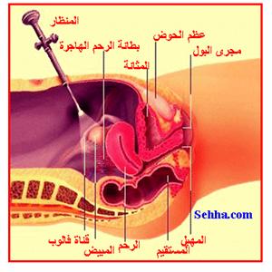 داء بطانة الرحم الهاجرة Endometriosis Endometriosis11