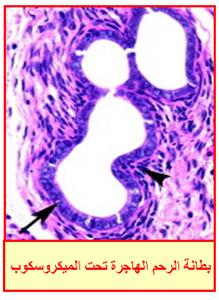 داء بطانة الرحم الهاجرة Endometriosis Endometriosis13