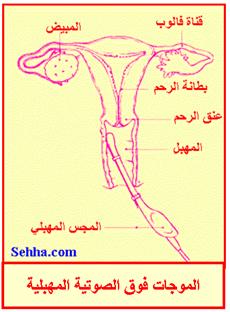 داء بطانة الرحم الهاجرة Endometriosis Endometriosis14