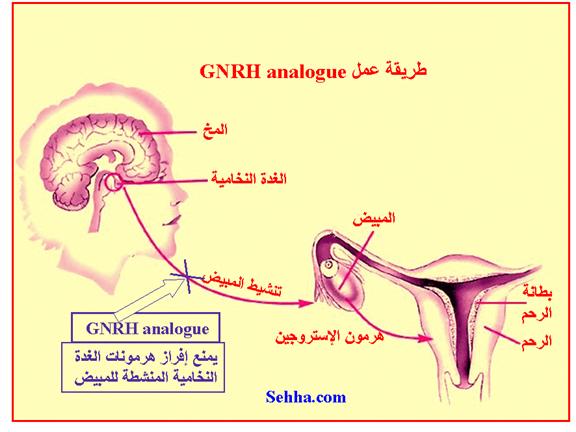 داء بطانة الرحم الهاجرة Endometriosis Endometriosis15