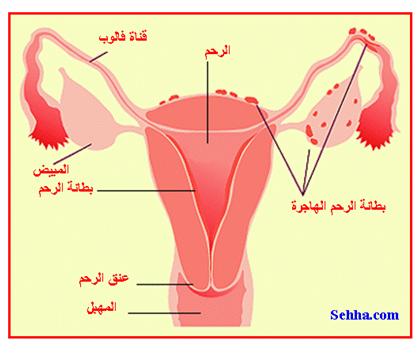 ما هو داء بطانة الرحم الهاجرة؟ What is endometriosis  Endometriosis4