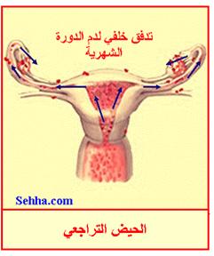 داء بطانة الرحم الهاجرة Endometriosis Endometriosis8
