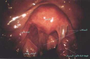 متلازمة تكيس المبايض Poly Cystic Ovaries - P.C.O Adhesion