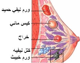 أمراض الثدي Breast diseases Breast1