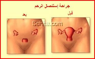 الألياف الرحمية - أورام الرحم الليفية Fibromyomas10