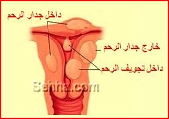 الألياف الرحمية - أورام الرحم الليفية Fibromyomas3