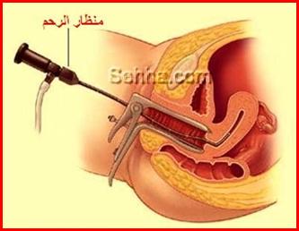 الألياف الرحمية - أورام الرحم الليفية Fibromyomas8