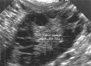 متلازمة تكيس المبايض Poly Cystic Ovaries - P.C.O Pco