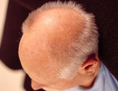 فوائد الصلع Bald-person