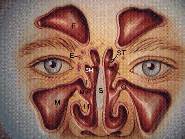 CT fo sinusitis Coronal4