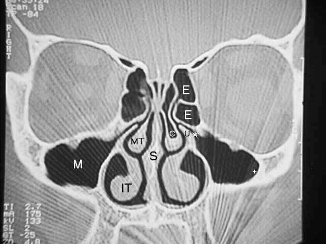 CT fo sinusitis Sinuct1a