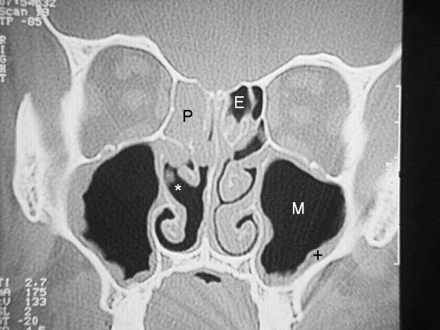 CT fo sinusitis Sinuct2a