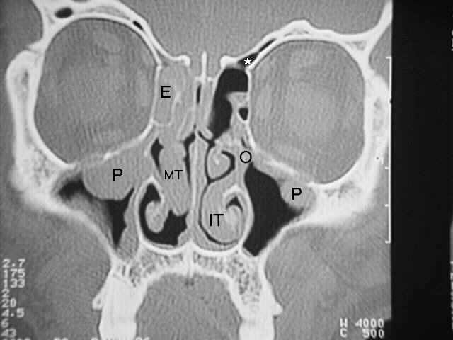 CT fo sinusitis Sinuct3a