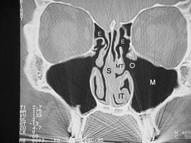 CT fo sinusitis Sinuct4a