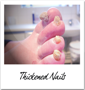 هل تشير أظافرك إلى مشكلة صحية؟  Thickened-nails