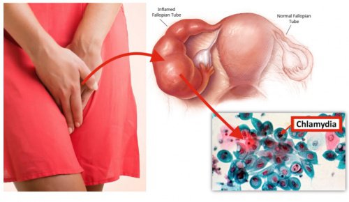 Bệnh nấm Chlamydia là gì - dấu hiệu, triệu chứng, cách chữa và tác hại Benh-chlamydia-o-nu-gioi