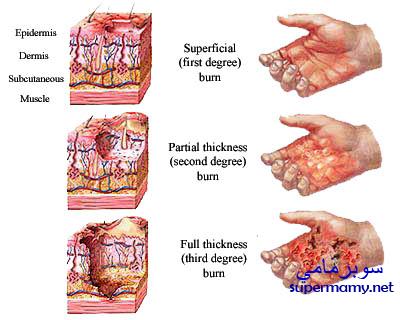 الاسعافات الاولية للأطفال عند الاحتراق Supermamy-42b282ccea
