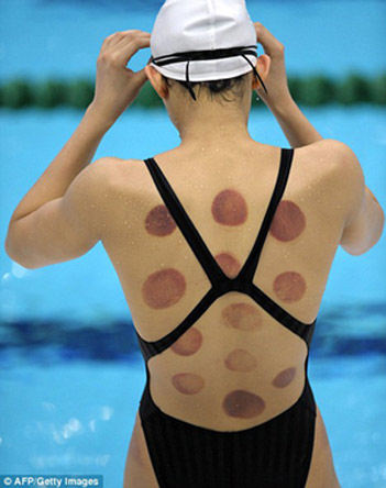 Holistic Muscle & Joint Pain Relief - The 2016 Olympic Way = Cuping  Cupping