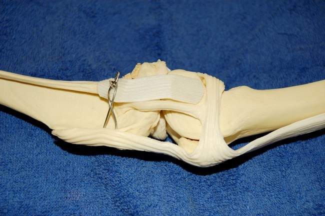 Rupture des ligaments croisés - Page 2 Rondaopegreffe