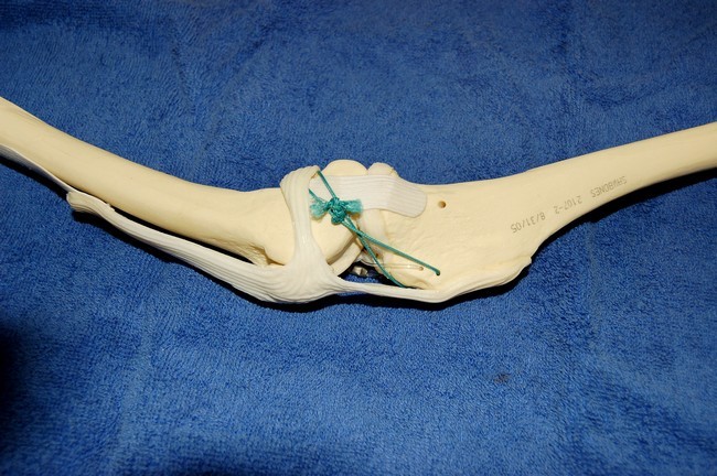 rotule - Rupture des ligaments croisés - Page 2 Rondaopenormal2