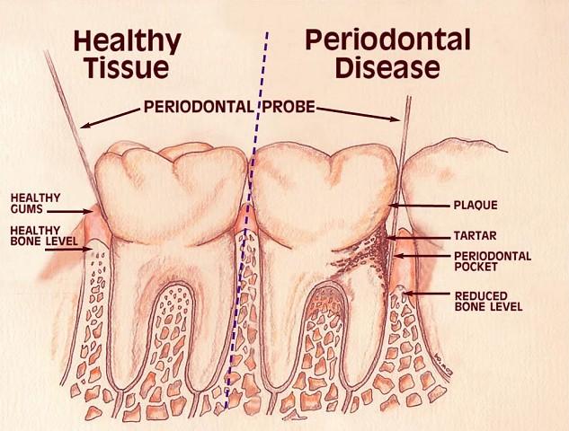 Chronic Periodontitis  2472